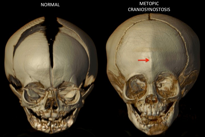 Metopic synostosis in children - Children's Health Craniofacial Surgery