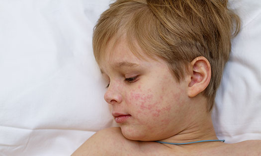 Thumbnail for Measles facts: 8 myths debunked