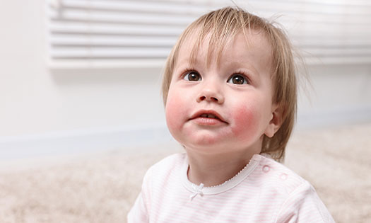 Thumbnail for Parvovirus B19: What parents need to know about fifth disease