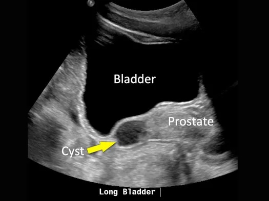 Seminal-Vesicle-cyst-525x394